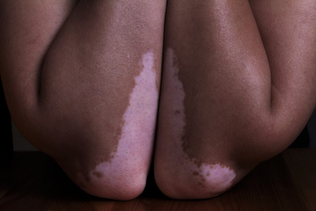 vitiligo repigmentation on its own
