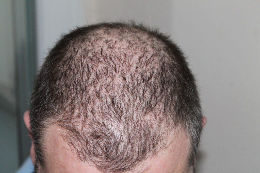 alopecia areata regrowth signs
