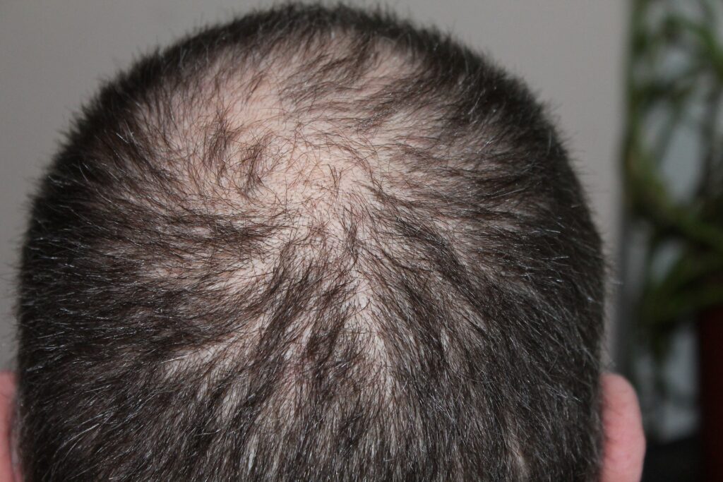 corticosteroids for alopecia areata 

